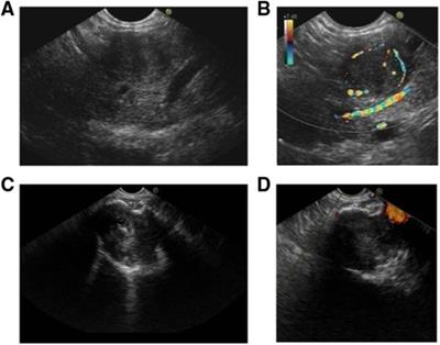 Multimodality imaging differentiation of pancreatic neuroendocrine tumors and solid pseudopapillary tumors with a nomogram model: A large single-center study